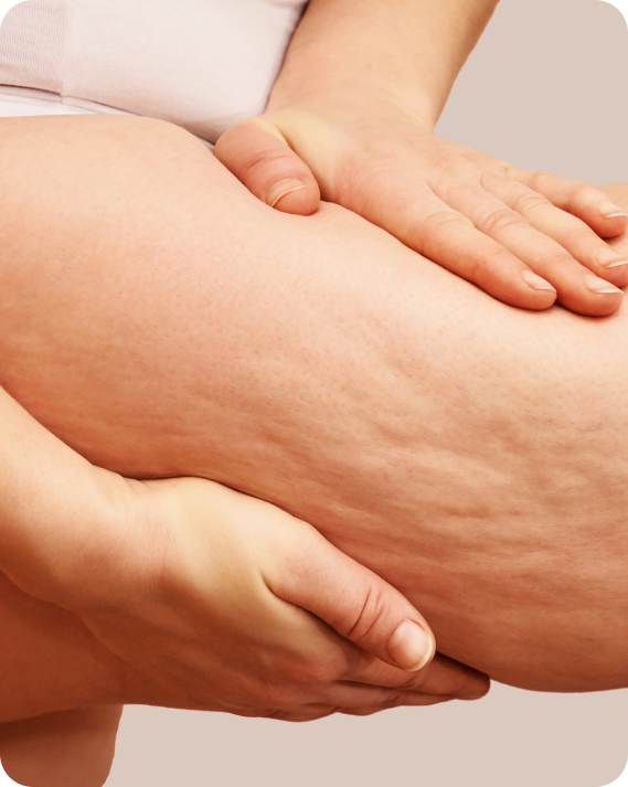 Nutricao no lipedema em Curitiba