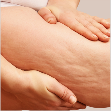 Nutricao no lipedema