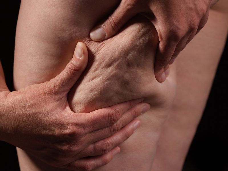 Consultoria em nutricao para lipedema em Curitiba