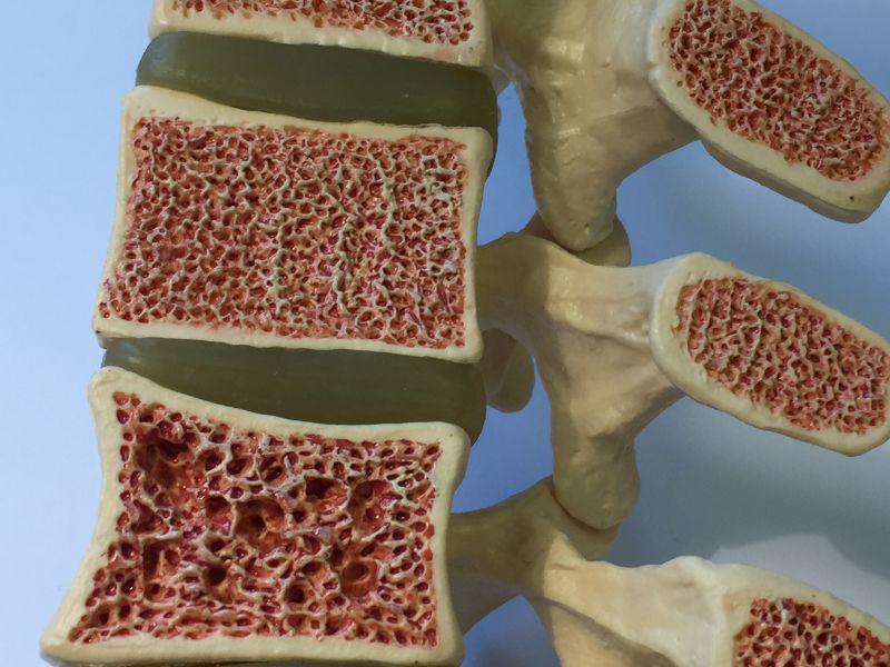 Nutricionista para Osteoporose Pos Menopausa em Curitiba